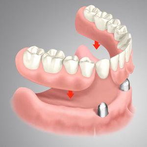 Herausnehmbarer implantatgetragener Zahnersatz mit Locator