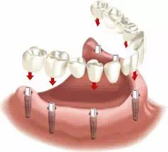 Festsitzende Zahnbrücken (Zahnersatz) auf Implantaten